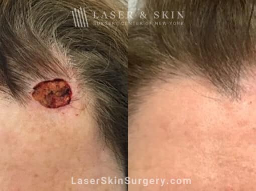 Mohs surgery to treat skin cancer on forehead