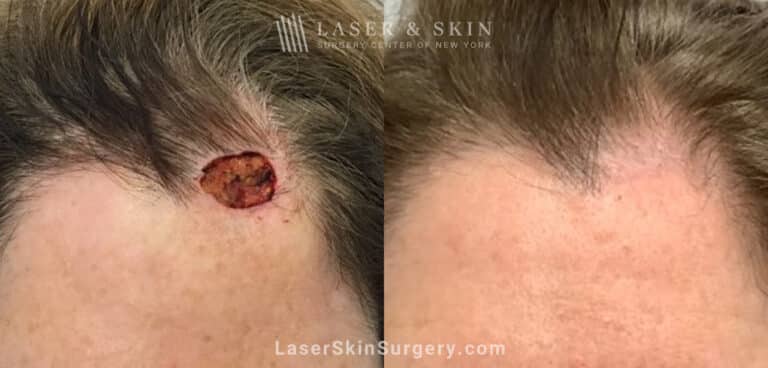 Mohs surgery to treat skin cancer on forehead