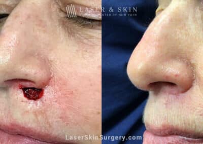 Mohs surgery to treat skin cancer near nose