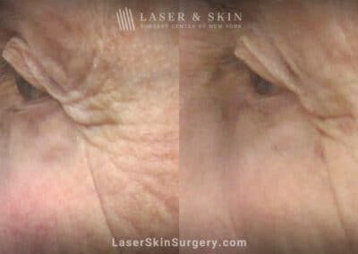 RHA filler to treat crow’s feet