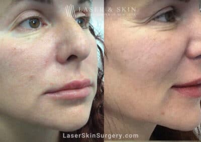 RHA filler to treat cheeks, smile lines, and corners of mouth