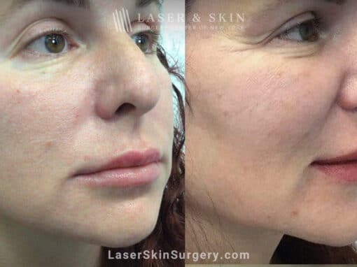 RHA filler to treat cheeks, smile lines, and corners of mouth