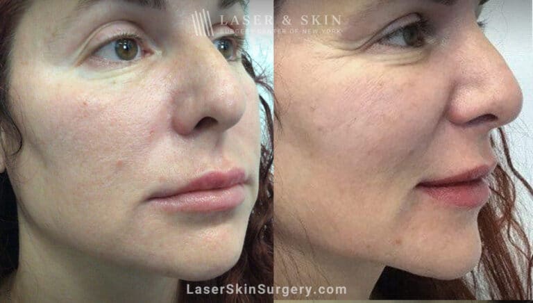 RHA filler to treat cheeks, smile lines, and corners of mouth