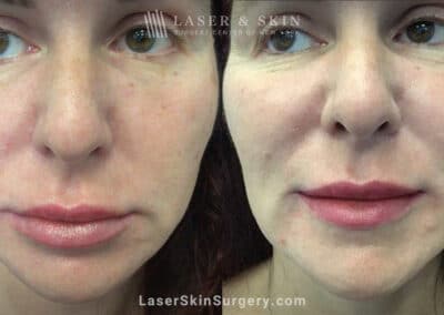 RHA filler to treat cheeks, smile lines, and corners of mouth