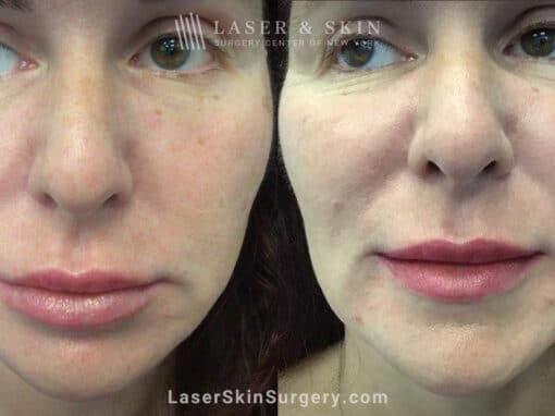 RHA filler to treat cheeks, smile lines, and corners of mouth