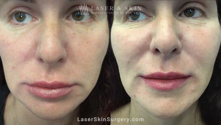 RHA filler to treat cheeks, smile lines, and corners of mouth