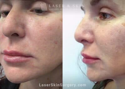 RHA filler to treat cheeks, smile lines, and corners of mouth