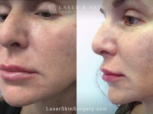 RHA filler to treat cheeks, smile lines, and corners of mouth