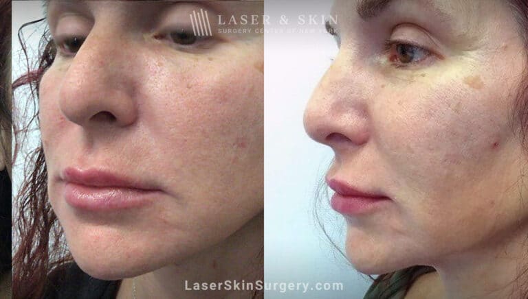 RHA filler to treat cheeks, smile lines, and corners of mouth