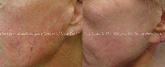 facial redness treatment-NYC-NY facial redness treatment options in NY, NY