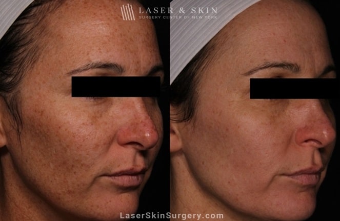 laser treatment results to restore even skin tone