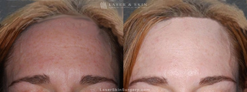 minimize wrinkles-NY-NY Botox injections results to reduce wrinkles in NY, NY