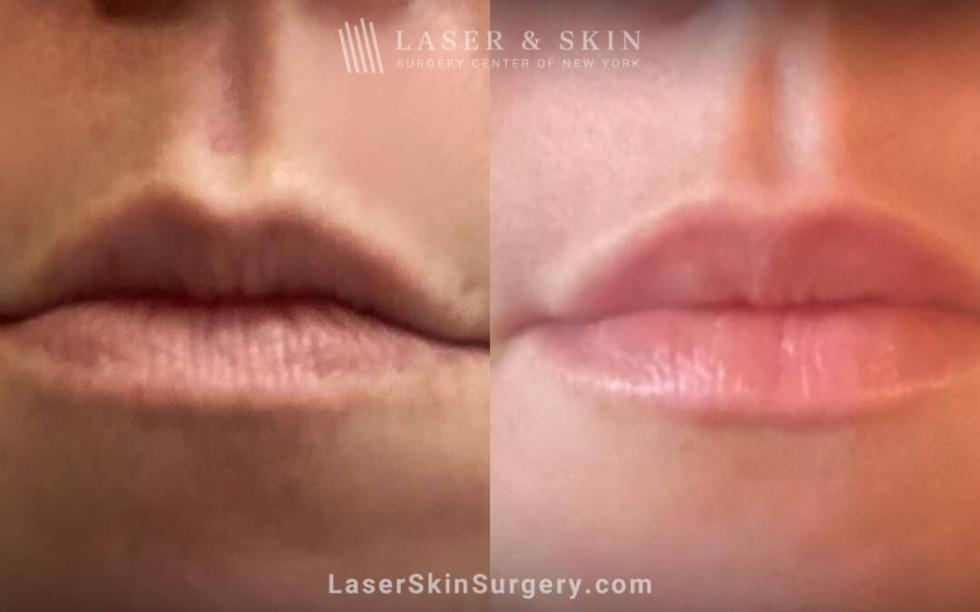 neuromodulators and lip fillers before and after