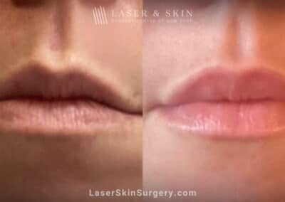 Lip filler to add fullness to the lips