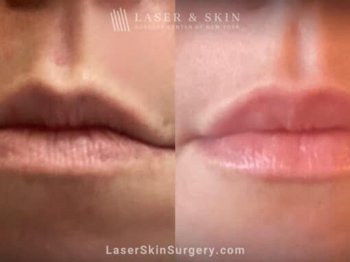 Lip filler to add fullness to the lips