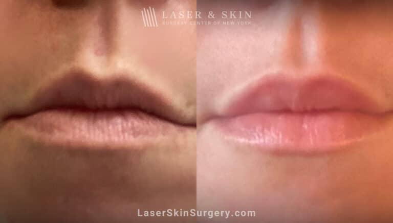 Lip filler to add fullness to the lips