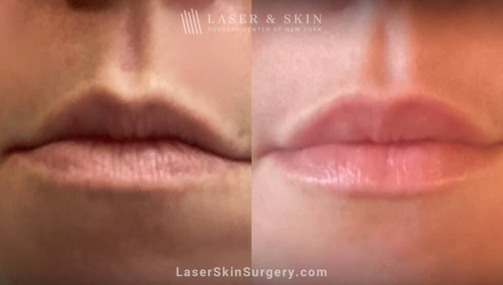 Dermatologists Share 6 Best Treatments for Wrinkles Above Lips in 2023 Laser NY