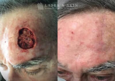 Mohs Surgery to Treat Skin Cancer on Forehead