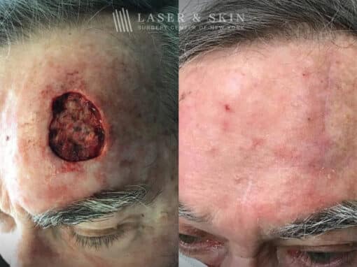 Mohs Surgery to Treat Skin Cancer on Forehead