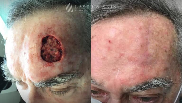 Mohs Surgery to Treat Skin Cancer on Forehead