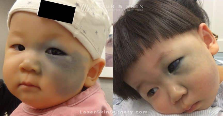 child nevus of ota treatment in NY