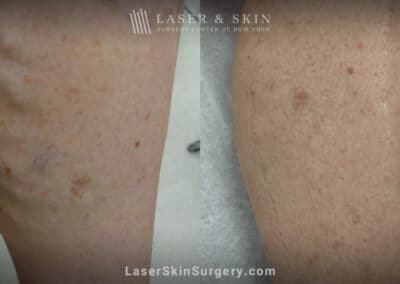 Sclerotherapy to treat leg veins