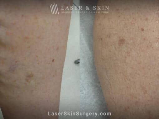 Sclerotherapy to treat leg veins