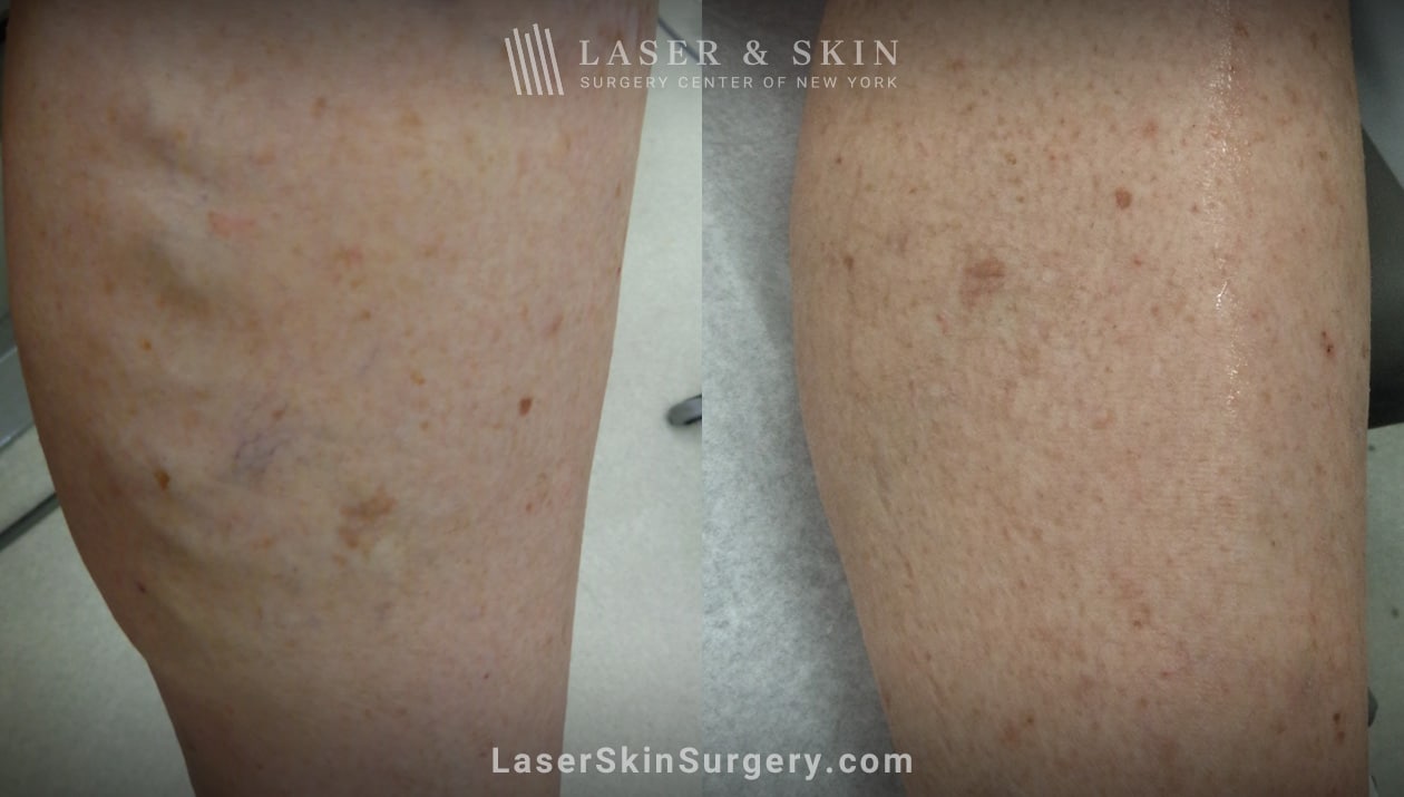 Laser and Skin Surgery Center of New York Image of a leg with Leg veins and after the treatment, New York, NY