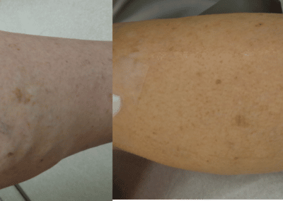 Sclerotherapy to treat leg veins