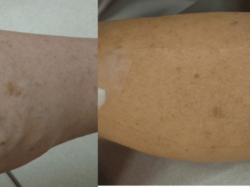 Sclerotherapy to treat leg veins