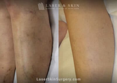 Sclerotherapy to treat leg veins