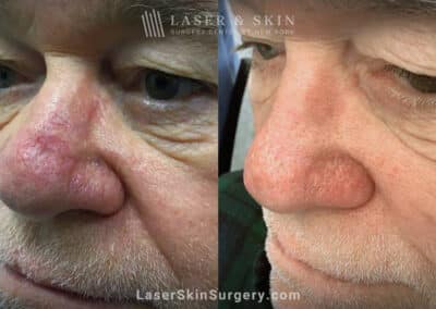 Vbeam to treat nose scar and redness