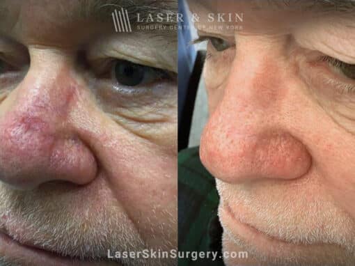 Vbeam to treat nose scar and redness