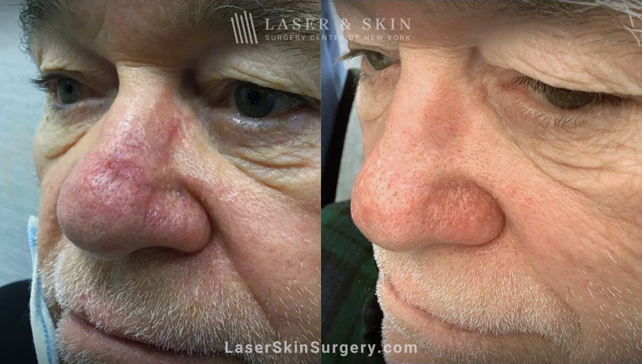 Vbeam-to-treat-scar-and-redness-nose-Shelton laser treatment to get rid of redness on the nose before and after