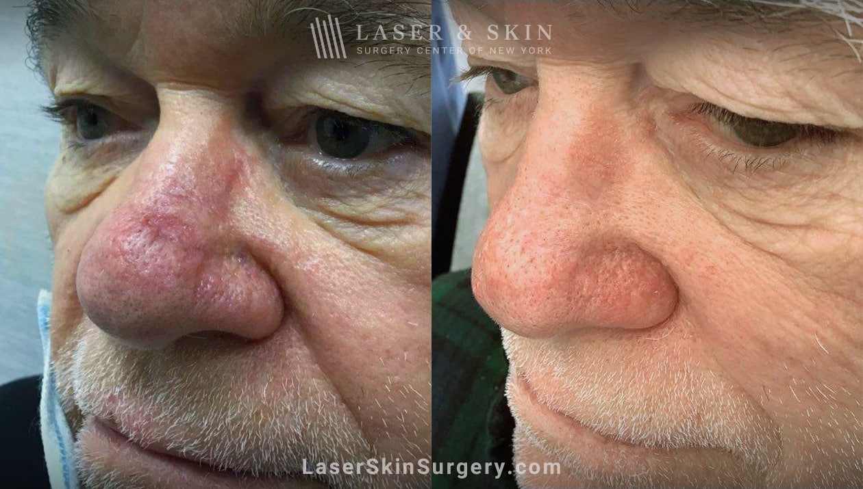 laser treatment to get rid of redness on the nose before and after