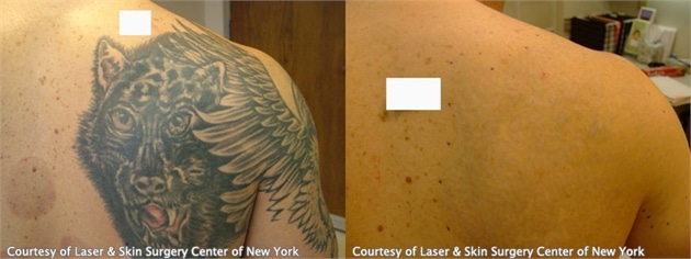 LSSCNY laser tattoo removal on back before and after results New York NY LSSCNY laser tattoo removal on back before and after results New York NY