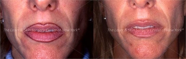 lsscny laser tattoo removal permanent makeup before and after new york ny