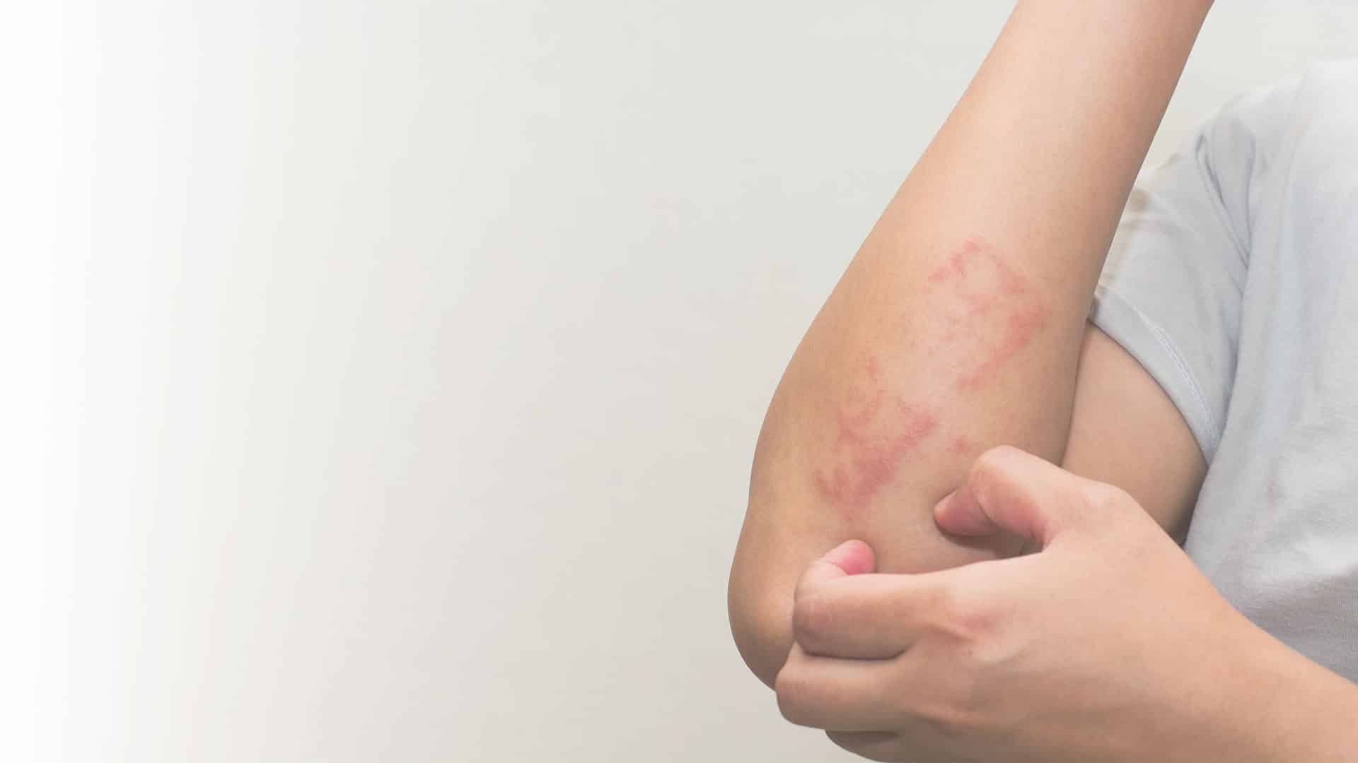 pediatric rashes treatment, NY, NY