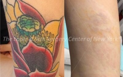 Why You Should Come To Us For Tattoo Removal