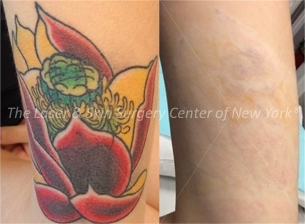 does tattoo removal work well