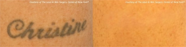 lsscny laser tattoo removal christine before and after new york ny