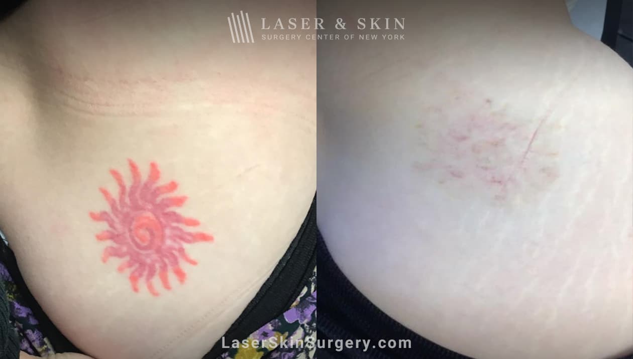 lsscny unwanted tattoo treatment results before and after new york ny