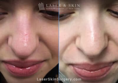 CO2 laser to treat nose scars