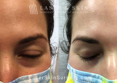 Laser treatment to remove red spots from patient’s face