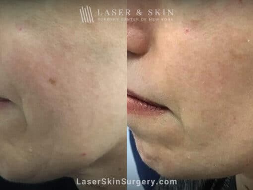 Ruby Laser to Treat Lentigo (brown spot) on Cheek