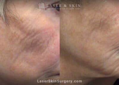 AquaGold microneedling for skin rejuvenation