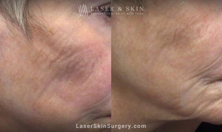 AquaGold microneedling for skin rejuvenation