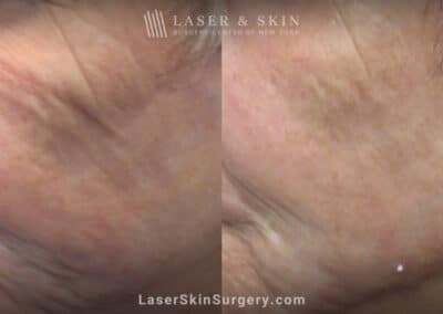 AquaGold microneedling for skin rejuvenation