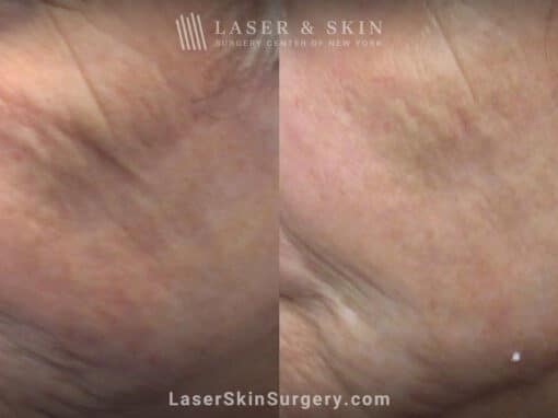 AquaGold microneedling for skin rejuvenation