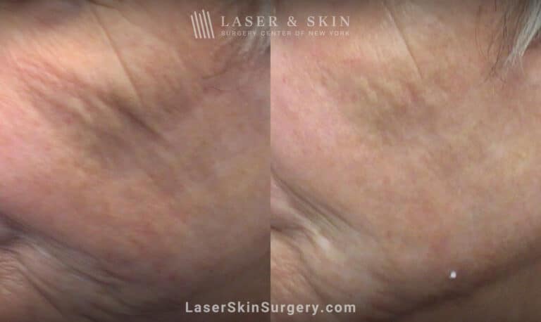 AquaGold microneedling for skin rejuvenation